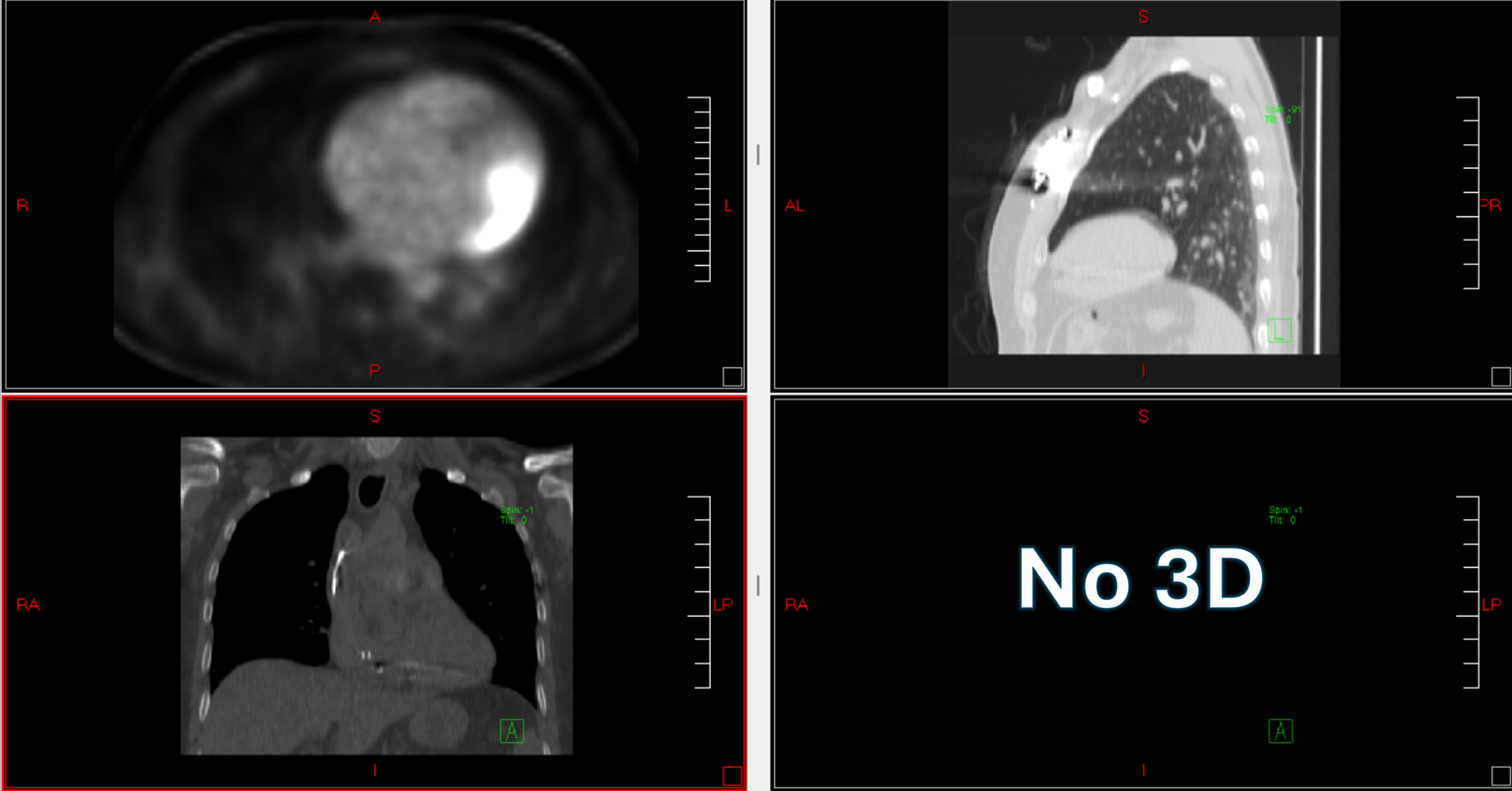 Traditional DICOM viewer with four panels showing flat 2D cross-sections and a 'No 3D' panel