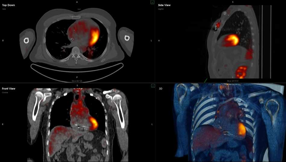MyBodyPrism showing CT-PET data across multiple synchronized 2D and 3D views