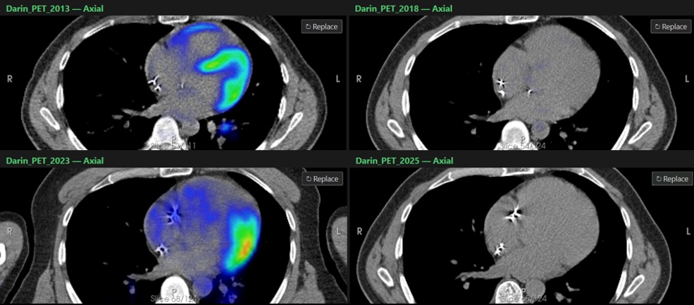 Side-by-side comparison of four cardiac PET-CT scans from 2013, 2018, 2023, and 2025