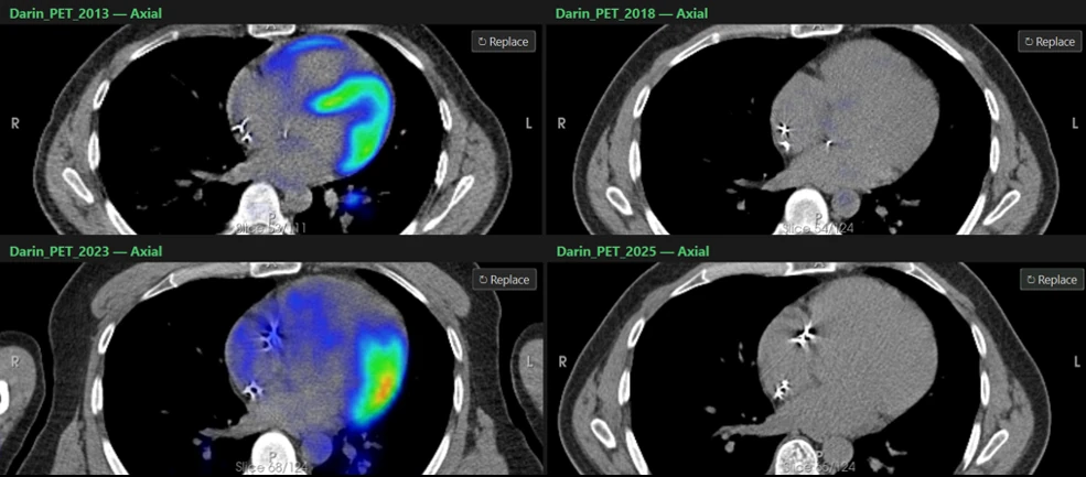 Side-by-side comparison of four cardiac PET-CT scans from 2013, 2018, 2023, and 2025