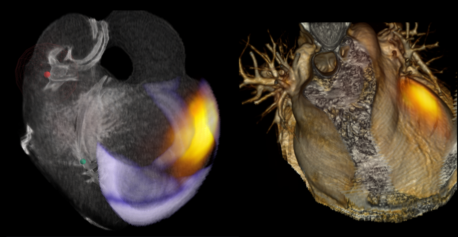 Volumetric 3D rendering of a human heart with PET signal and scar tissue visualized as a glowing heatmap