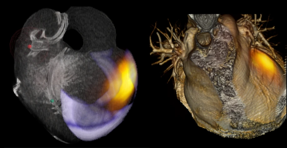 Volumetric 3D rendering of a human heart with PET signal and scar tissue visualized as a glowing heatmap