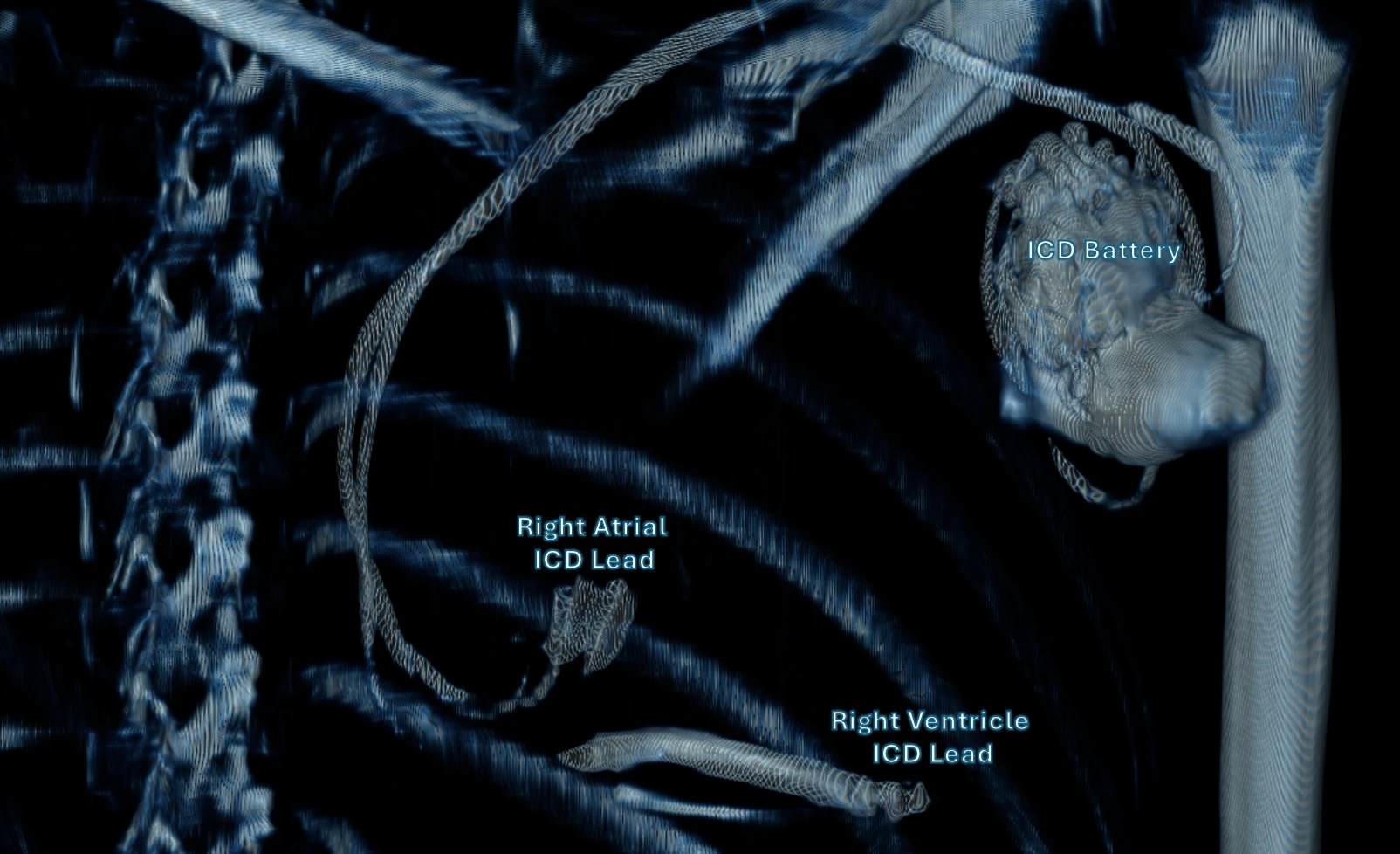 Volumetric CT render tuned to bone and metal density, revealing an implanted ICD, lead, and sternal wires