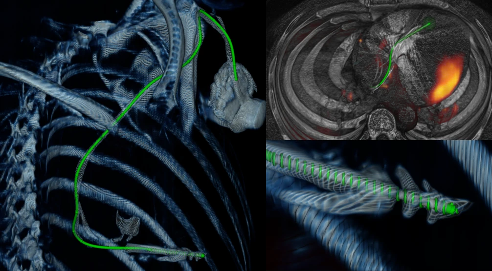 Annotation tool tracing an ICD lead through three views of the chest